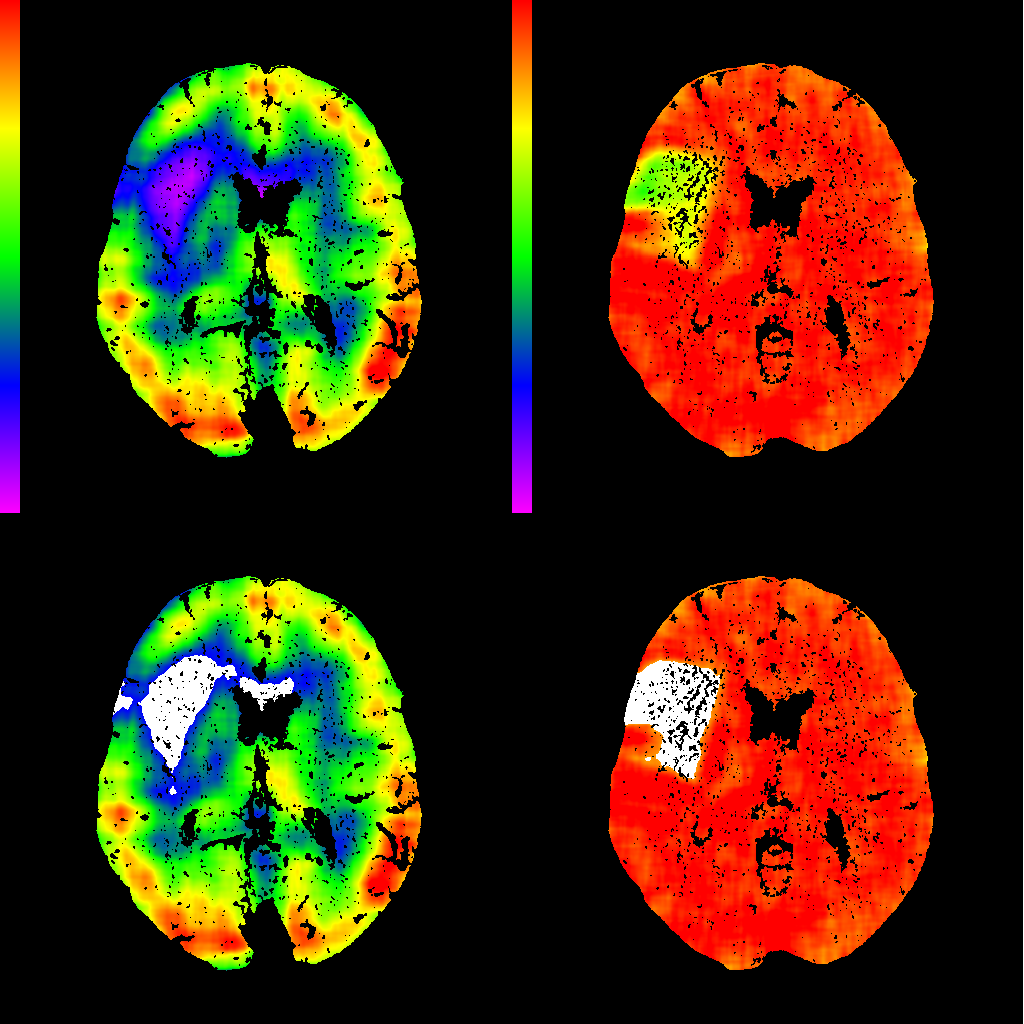 Infarction core delineation (white color), left column pictures are produced at admission time, right column are follow-up findings